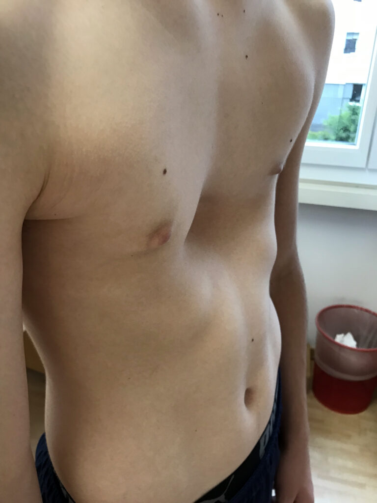 Pectus Excavatum, sunken chest, Deformity, Deflated, Abnormality, sunken, hole,