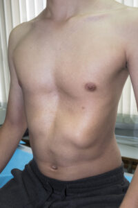 Pectus Excavatum, sunken chest, Deformity, Deflated, Abnormality