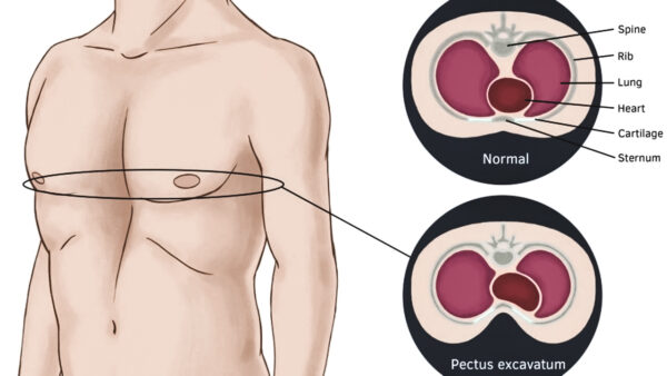 img_excavatum2-600x338