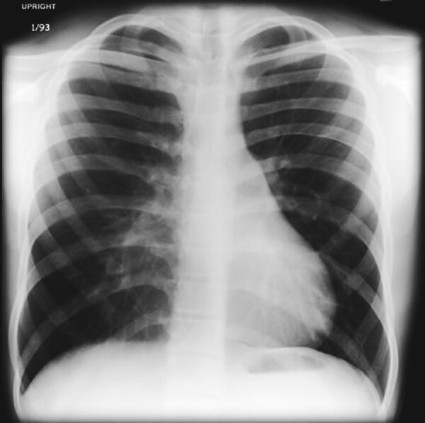 img_excavatum3-600x597