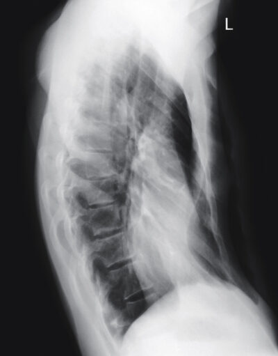 img_excavatum4-400x511