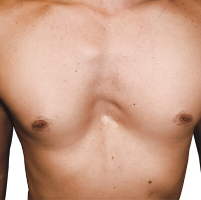 img_excavatum5-400x398