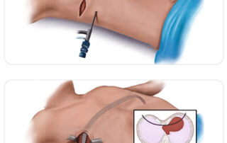 Nuss procedure