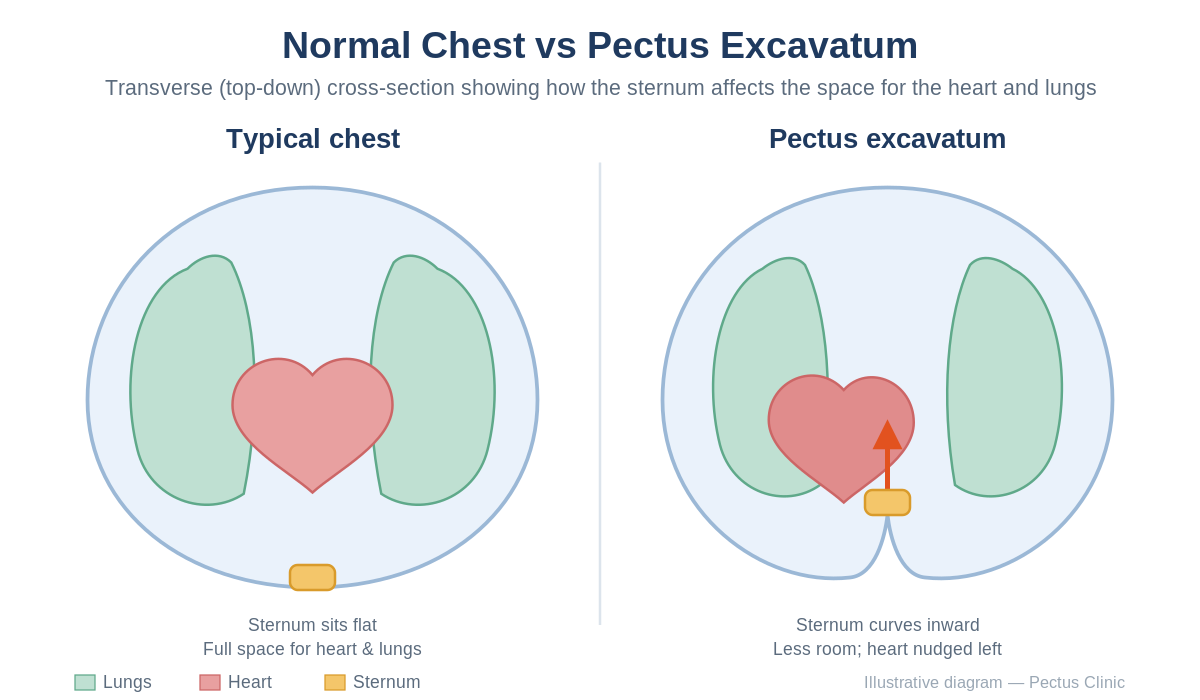 Diagram comparing a typical chest wall with a pectus excavatum (sunken chest) profile.